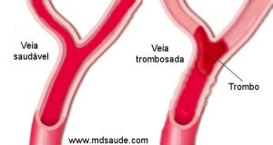 trombose